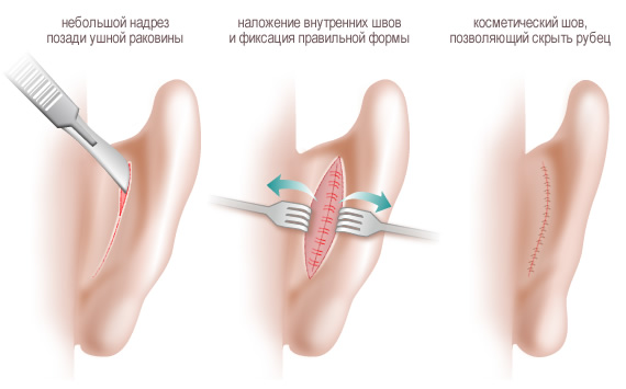Операция по уменьшению ушей. Фото до и после, цена, отзывы