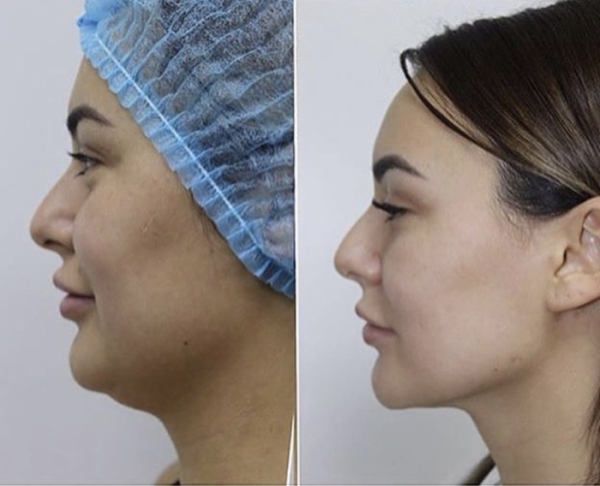 Хирургическая подтяжка нижней трети лица и шеи. Отзывы, фото до и после