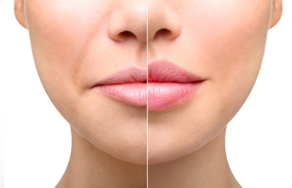 Биоревитализация губ. Отзывы, что это, фото до и после, эффективность