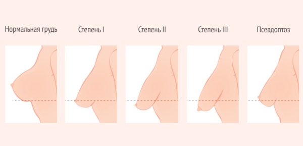 Туберозная деформация груди у женщин. Фото, как выглядит